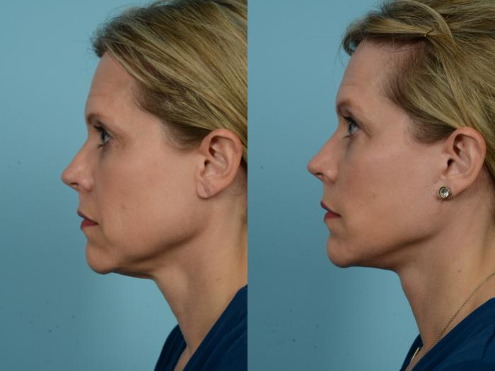 Before & After Dual Plane Facelift by Dr. Sinno Case 784 Left Side View in Chicago, IL