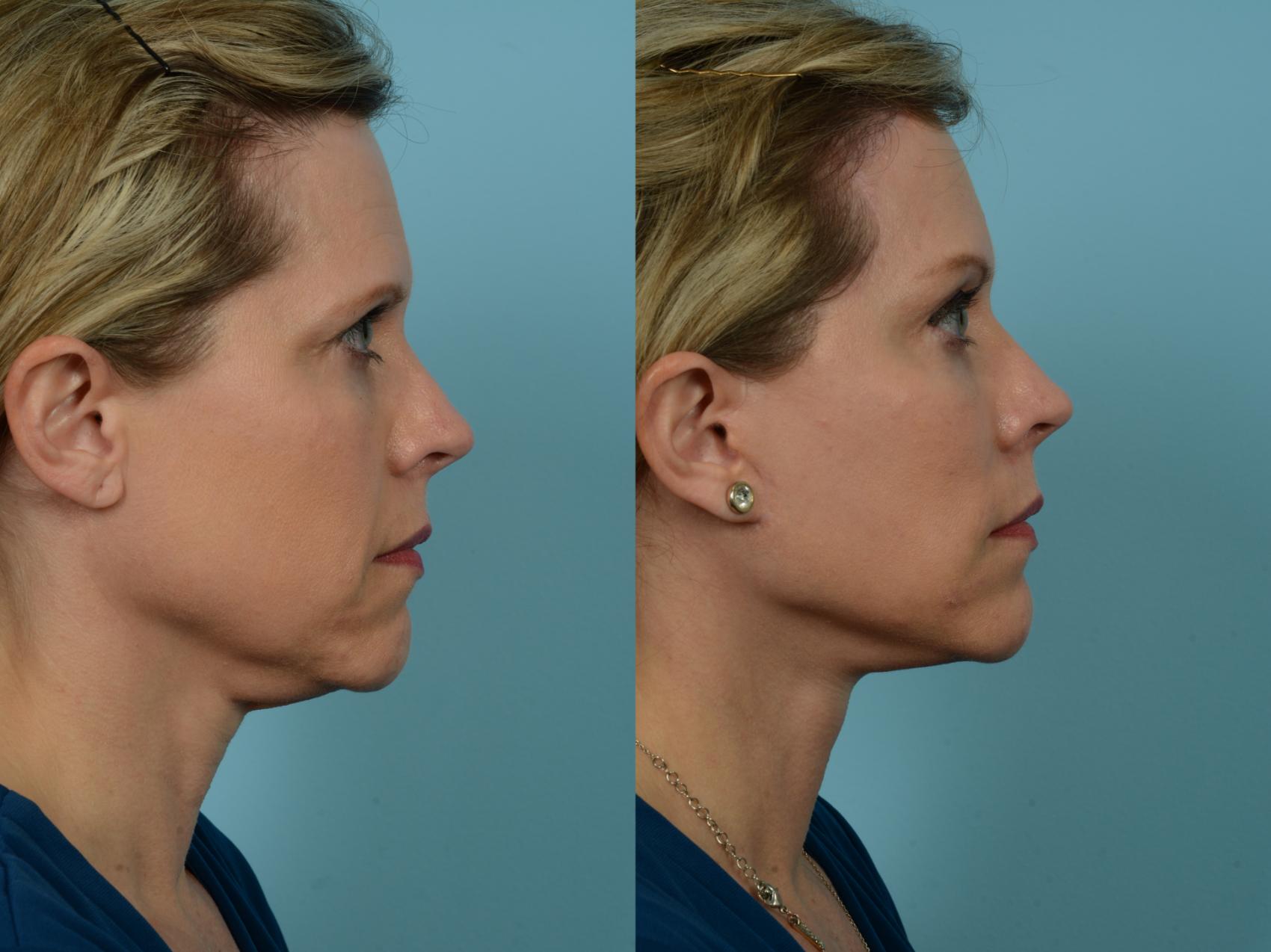 Before & After Brow Lift by Dr. Sinno Case 784 Right Side View in Chicago, IL