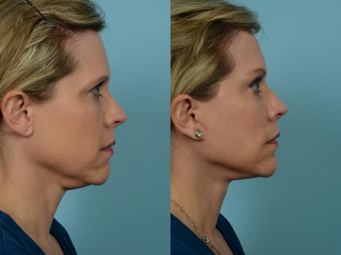 Before & After Dual Plane Facelift by Dr. Sinno Case 784 Right Side View in Chicago, IL