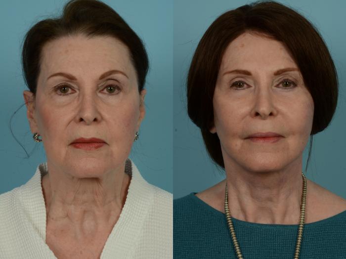 Before & After Dual Plane Facelift by Dr. Sinno Case 911 Front View in Chicago, IL