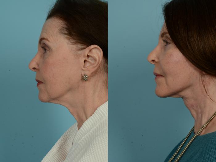 Before & After Dual Plane Facelift by Dr. Sinno Case 911 Left Side View in Chicago, IL