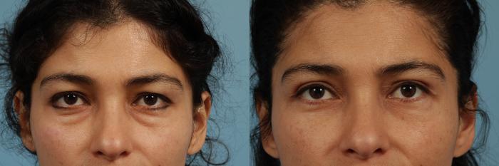Before & After Eyelid Surgery Case 319 View #1 View in Chicago, IL