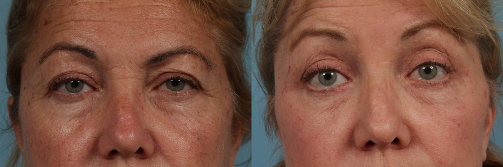 Before & After Eyelid Surgery Case 334 View #1 View in Chicago, IL