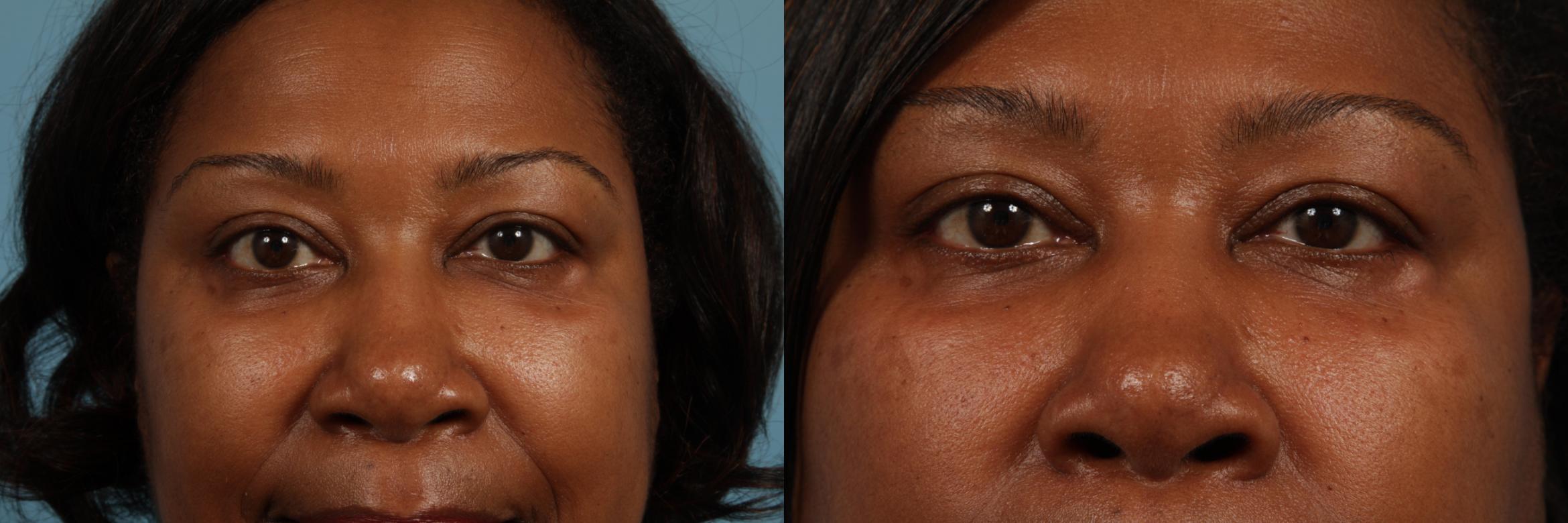 Before & After Eyelid Surgery Case 337 View #1 View in Chicago, IL