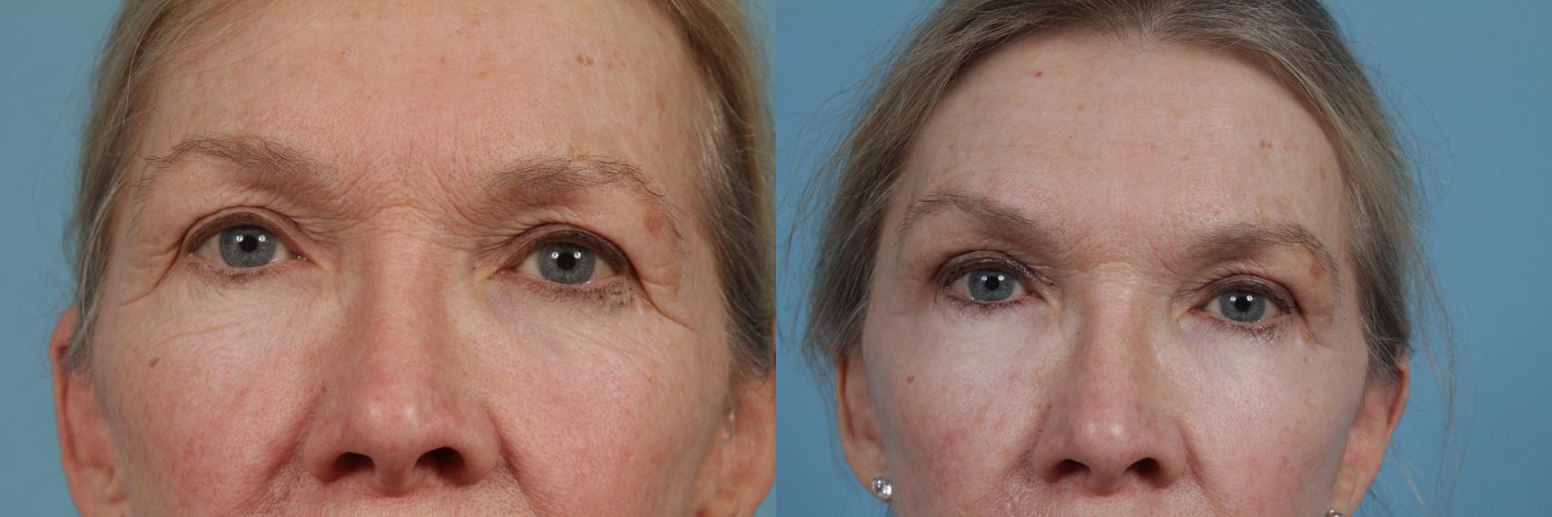 Before & After Eyelid Surgery Case 342 View #1 View in Chicago, IL