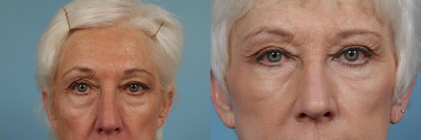 Before & After Eyelid Surgery Case 349 View #1 View in Chicago, IL