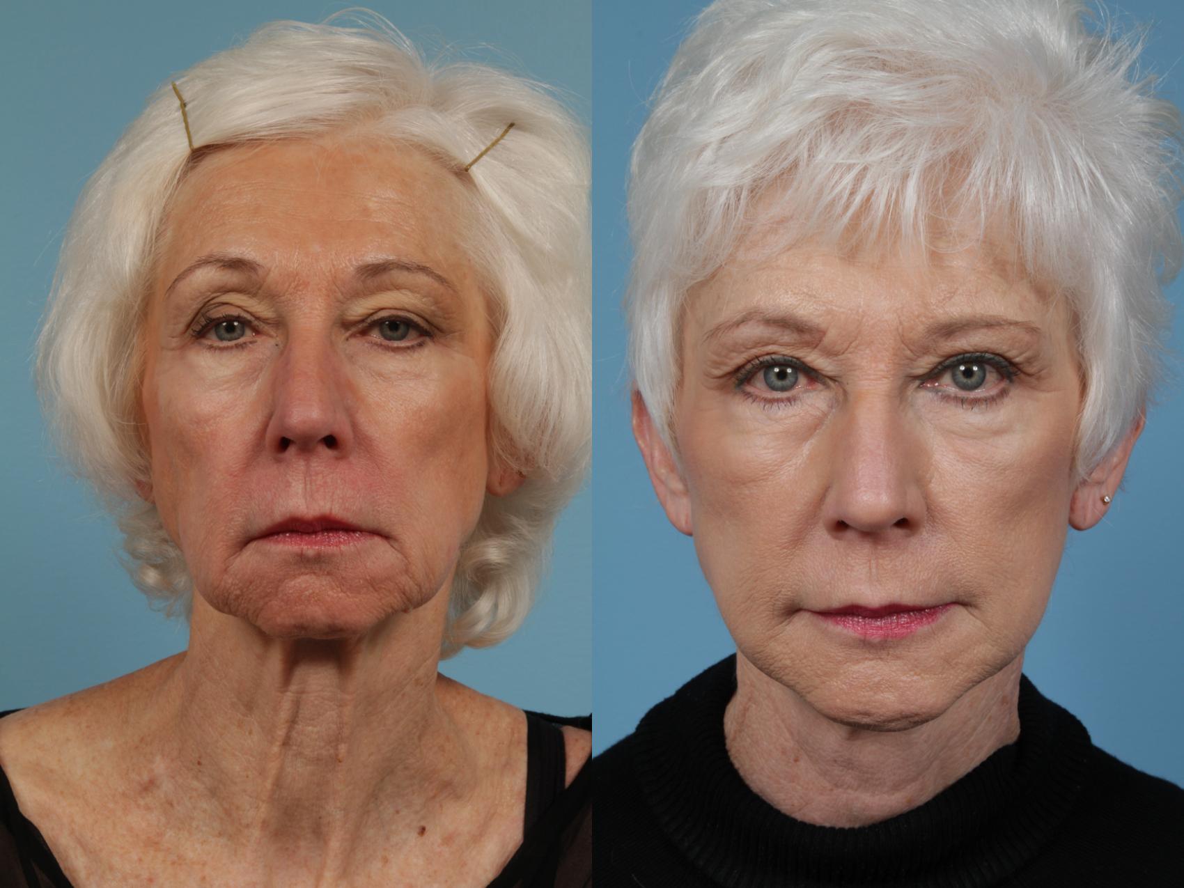 Before & After Eyelid Surgery Case 349 View #2 View in Chicago, IL