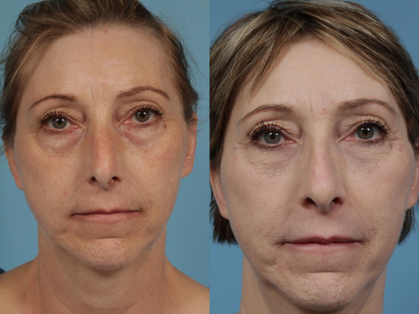 Before & After Eyelid Surgery Case 352 View #1 View in Chicago, IL
