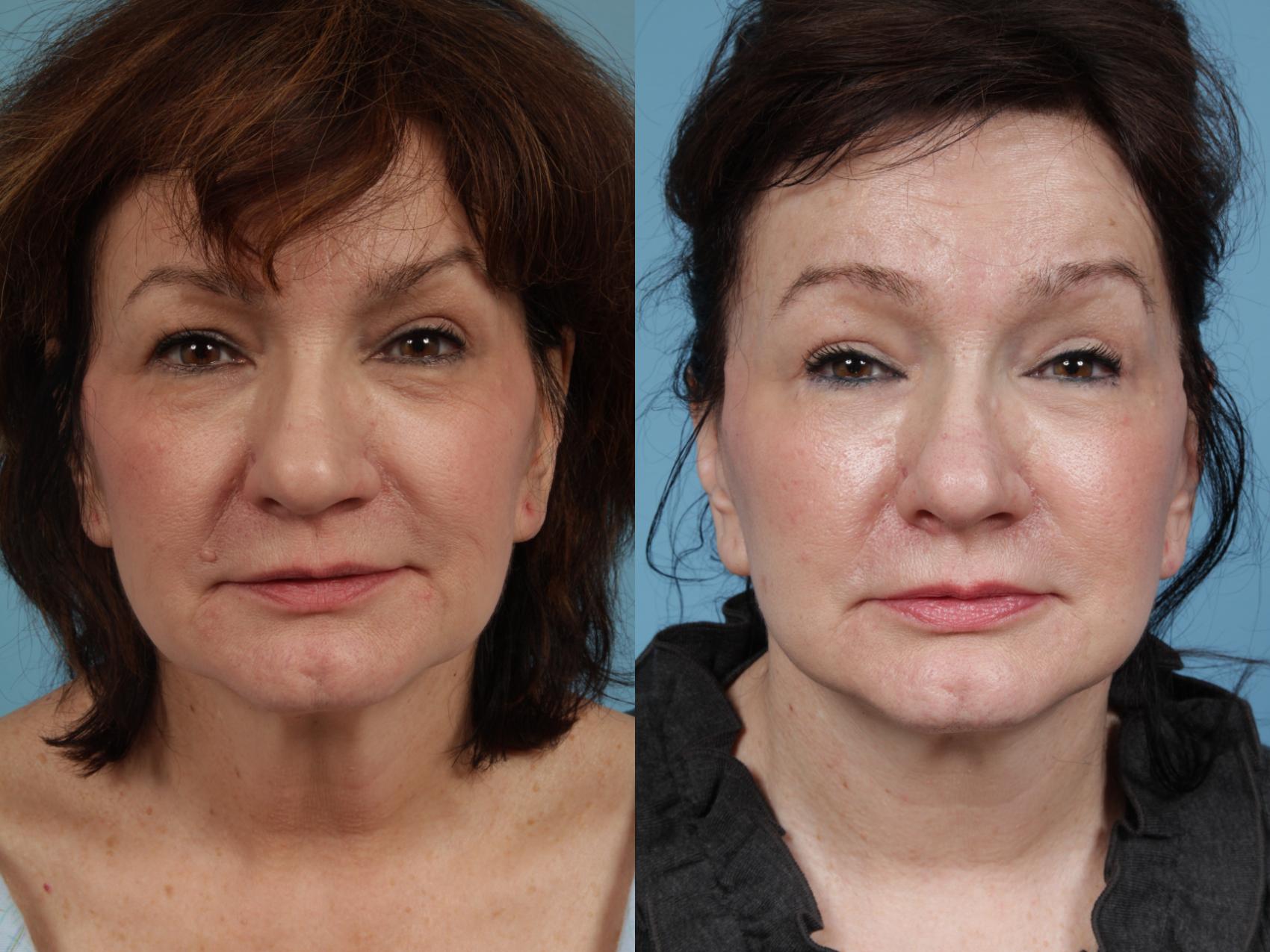 Before & After Eyelid Surgery Case 356 View #1 View in Chicago, IL