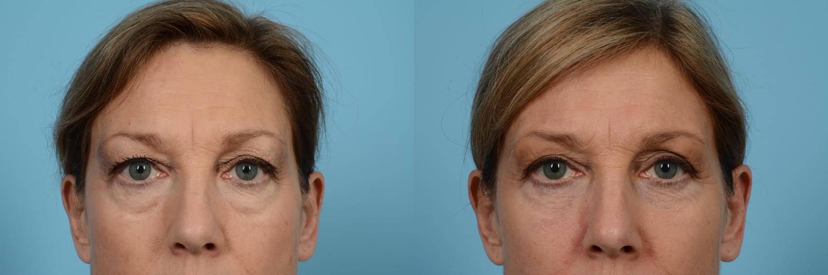 Before & After Eyelid Surgery Case 523 View #1 View in Chicago, IL