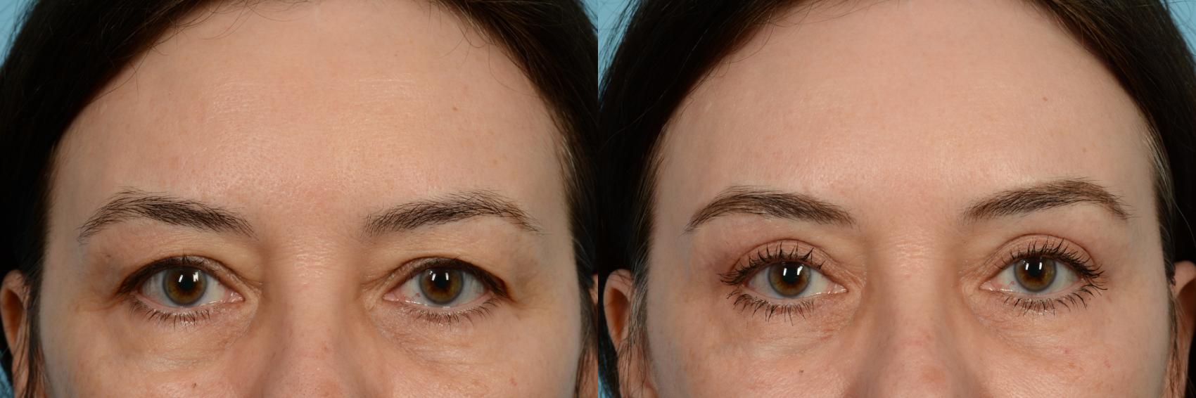 Eye Bags Surgery for Ethnic Skin  Puffy Eyes New York Cosmetic Surgery
