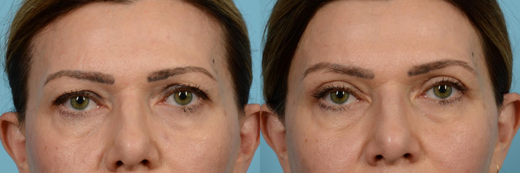 Eyelid Surgery Before And After Pictures Case 616 | Chicago, IL | TLKM ...