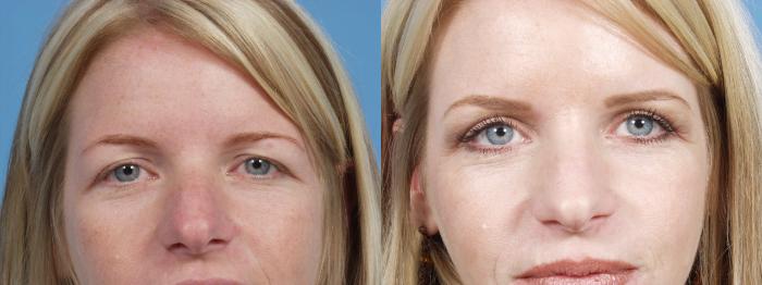 Before & After Eyelid Surgery Case 62 View #1 View in Chicago, IL