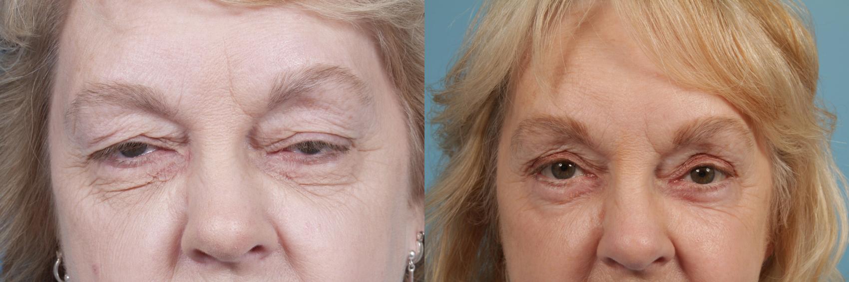 Before & After Eyelid Surgery Case 63 View #1 View in Chicago, IL