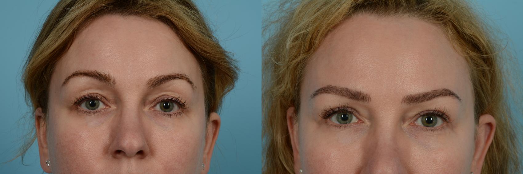 Eyelid Surgery Before And After Pictures Case 735 | Chicago, IL | TLKM ...