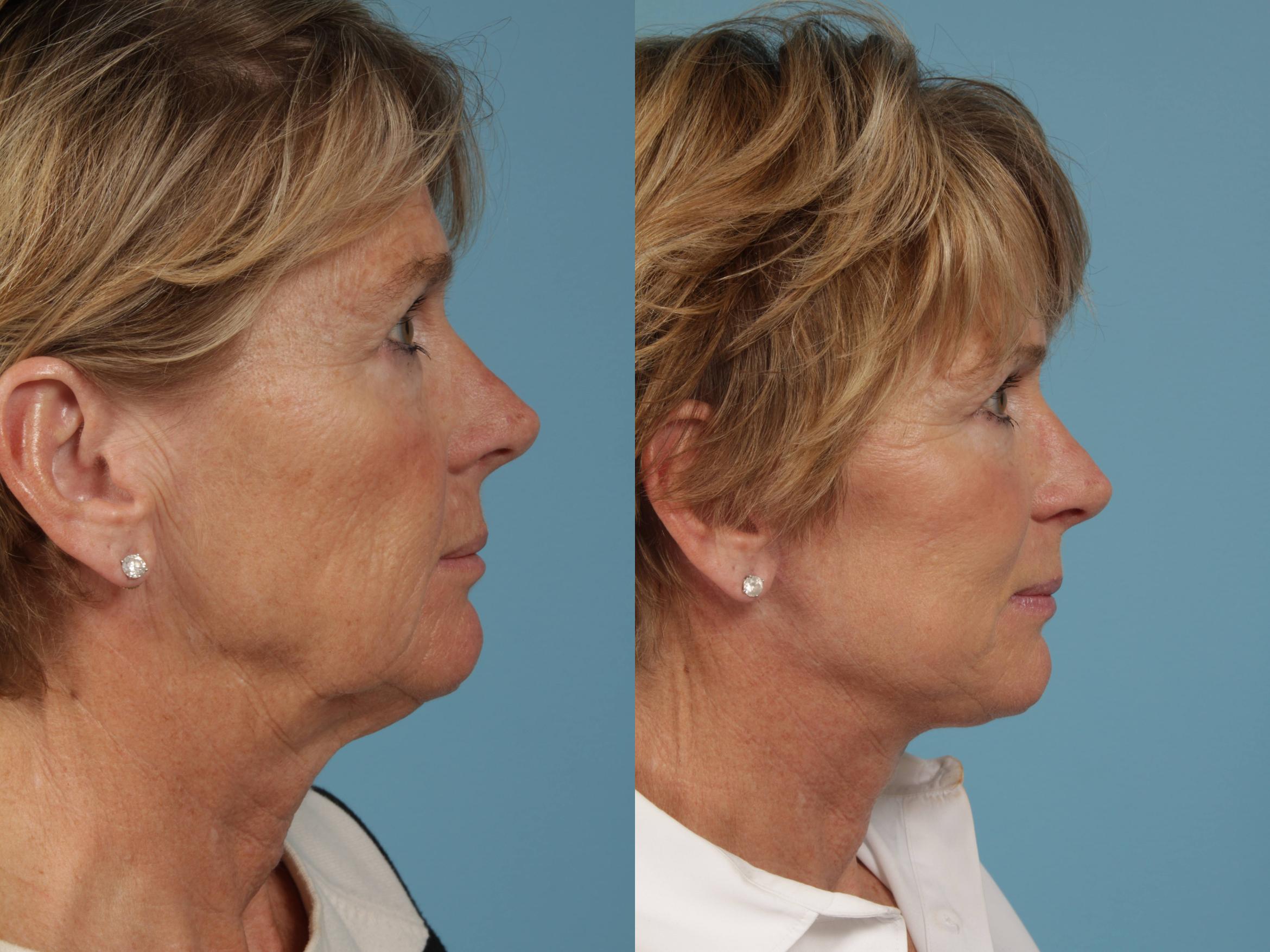 Before & After Eyelid Surgery Case 216 View #3 View in Chicago, IL