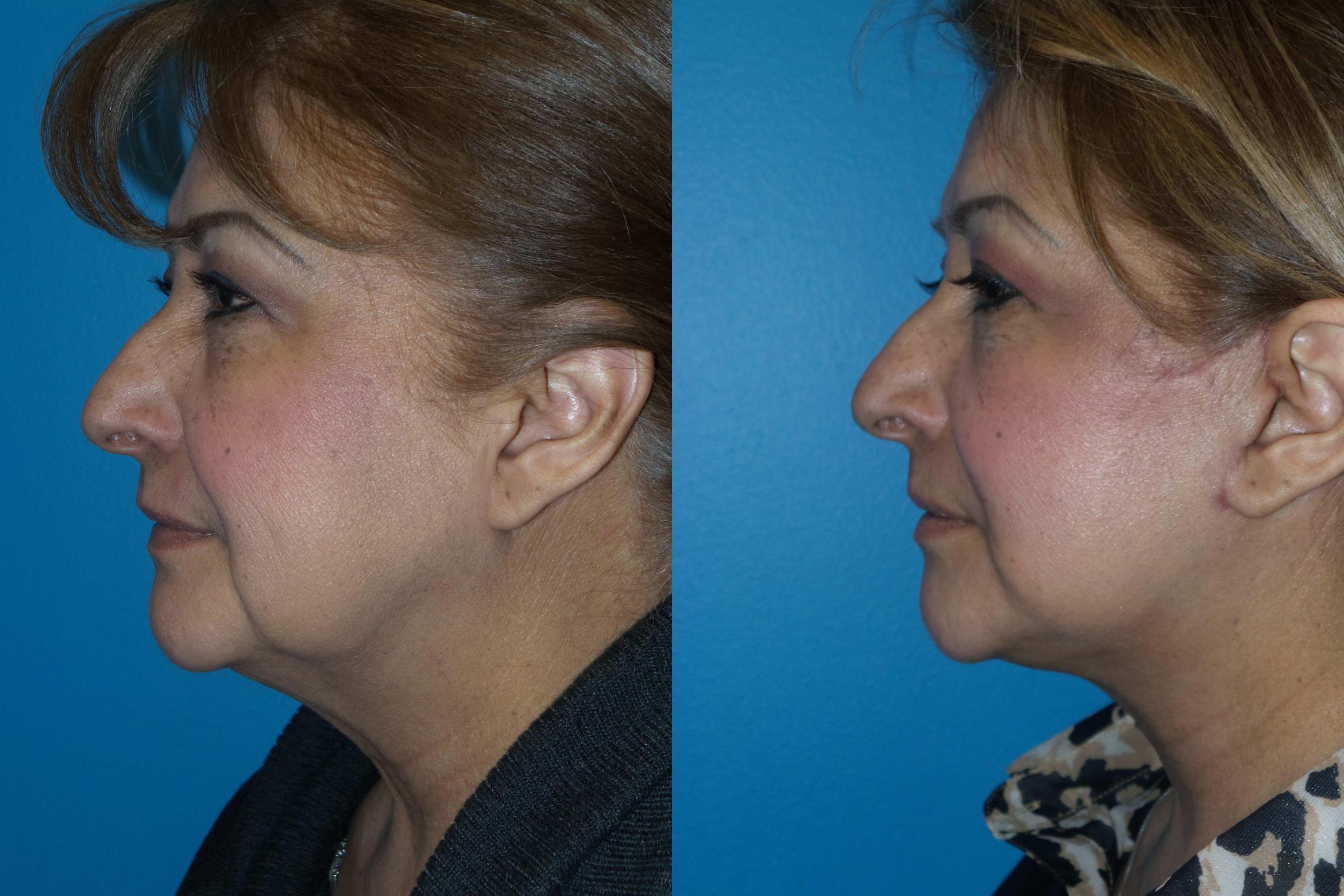 Before & After Facelift/Minilift Case 401 View #2 View in Chicago, IL