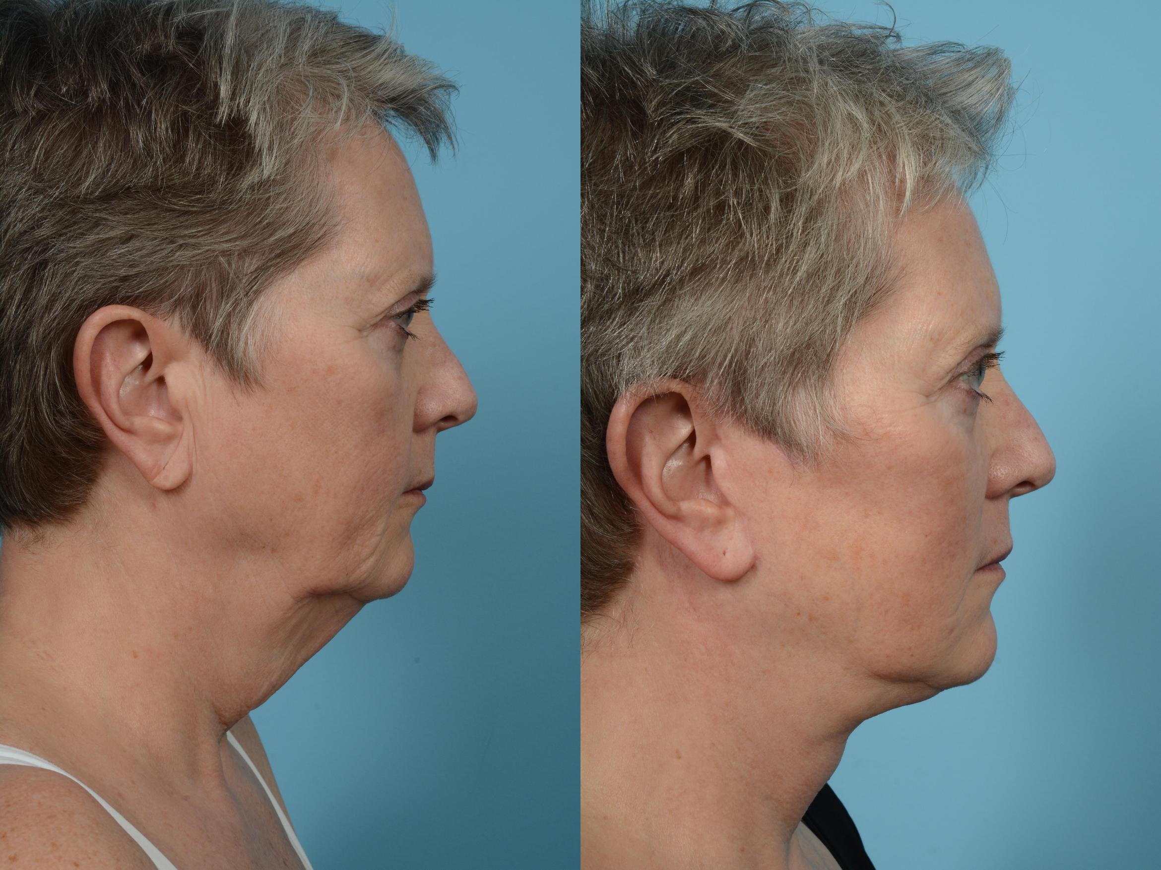 Before & After Facelift/Minilift Case 573 View #3 View in Chicago, IL