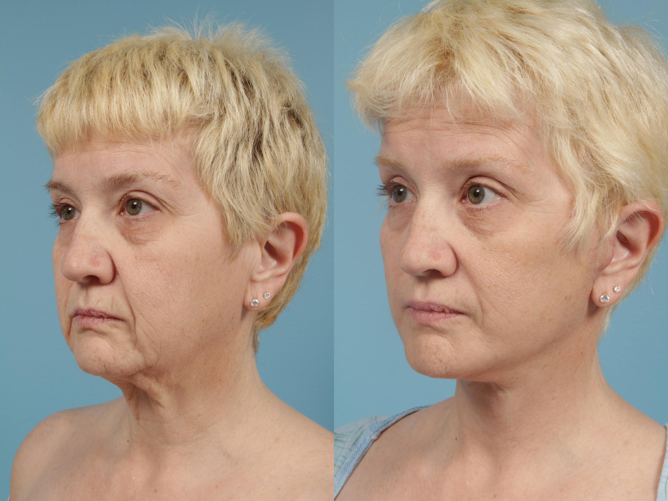 Before & After Facelift/Minilift by Dr. Mustoe Case 170 View #2 View in Chicago, IL