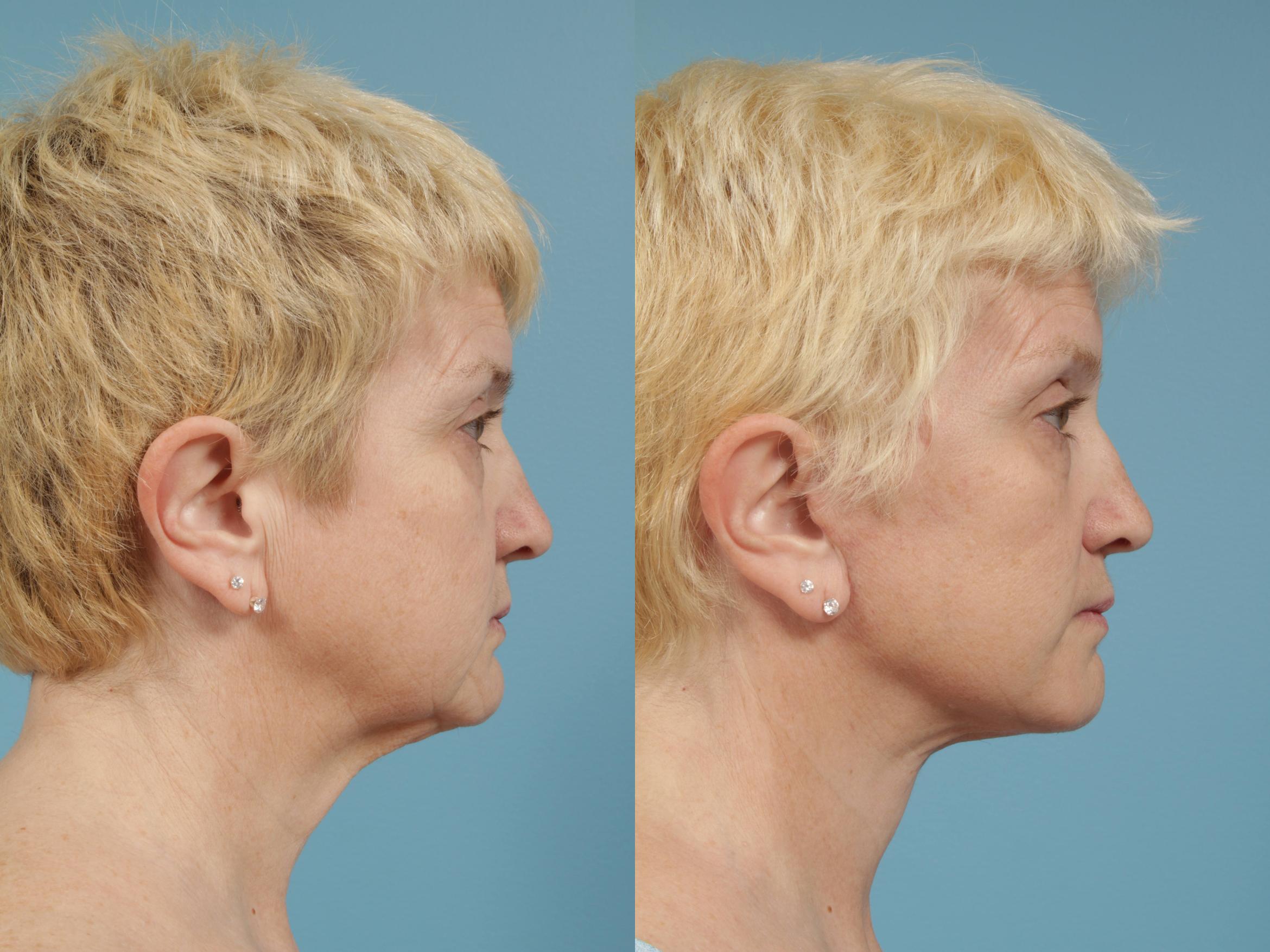 Before & After Facelift/Minilift by Dr. Mustoe Case 170 View #3 View in Chicago, IL