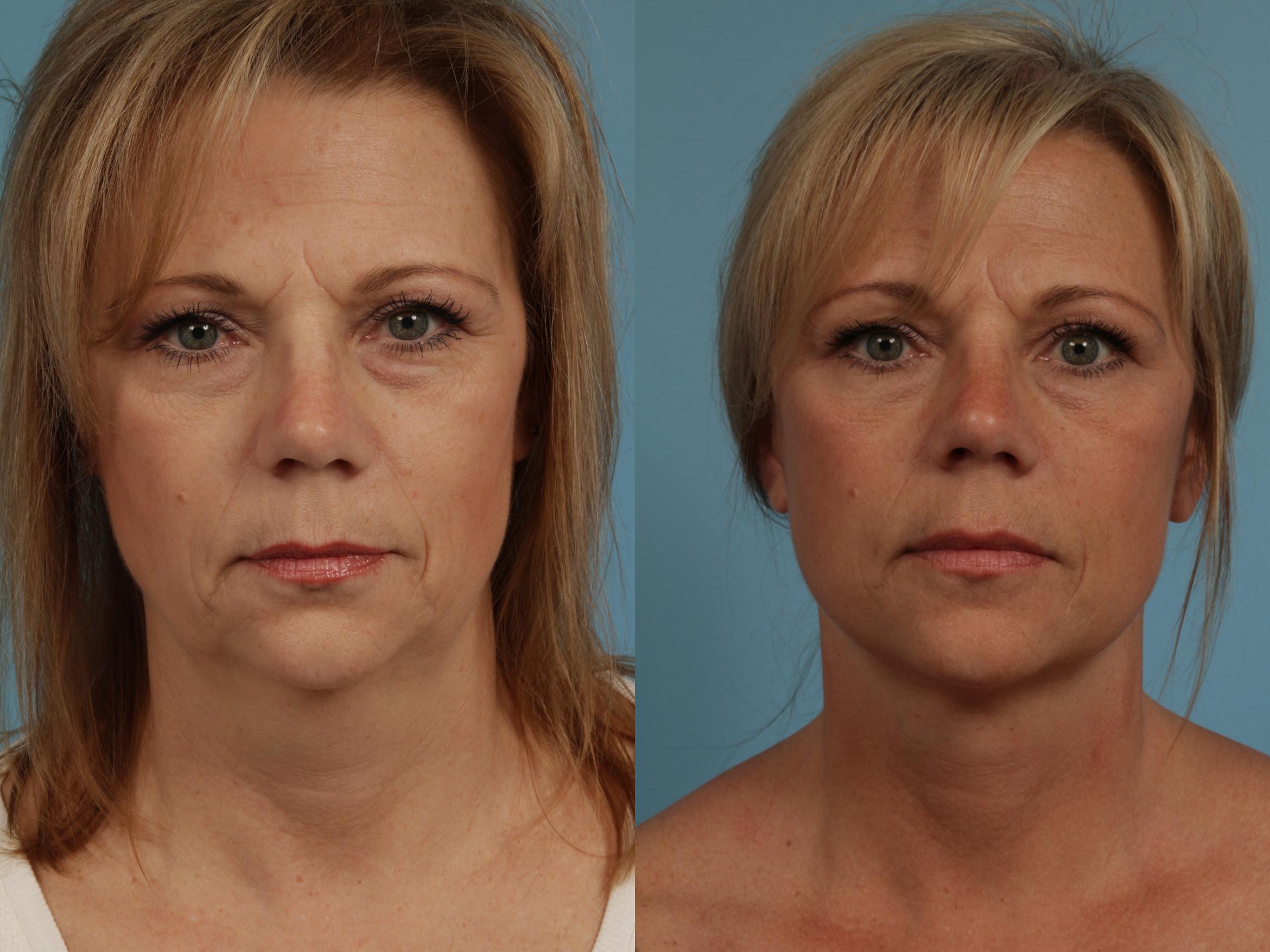 Before & After Facelift/Minilift by Dr. Mustoe Case 274 View #2 View in Chicago, IL