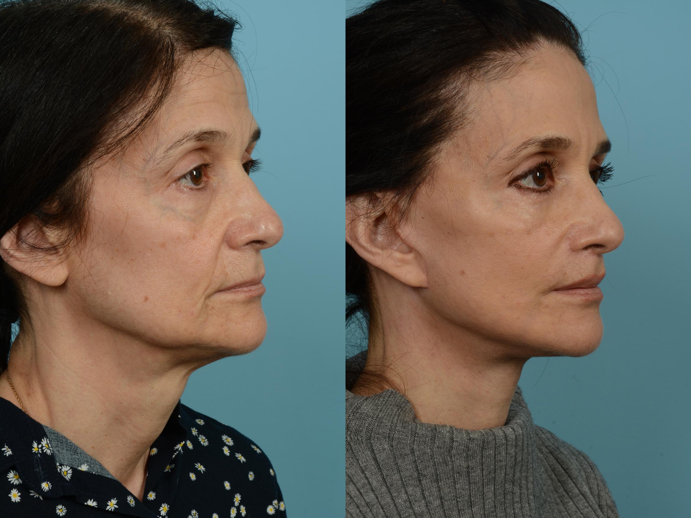 Before & After Facelift/Minilift Case 803 Right Oblique View in Chicago, IL