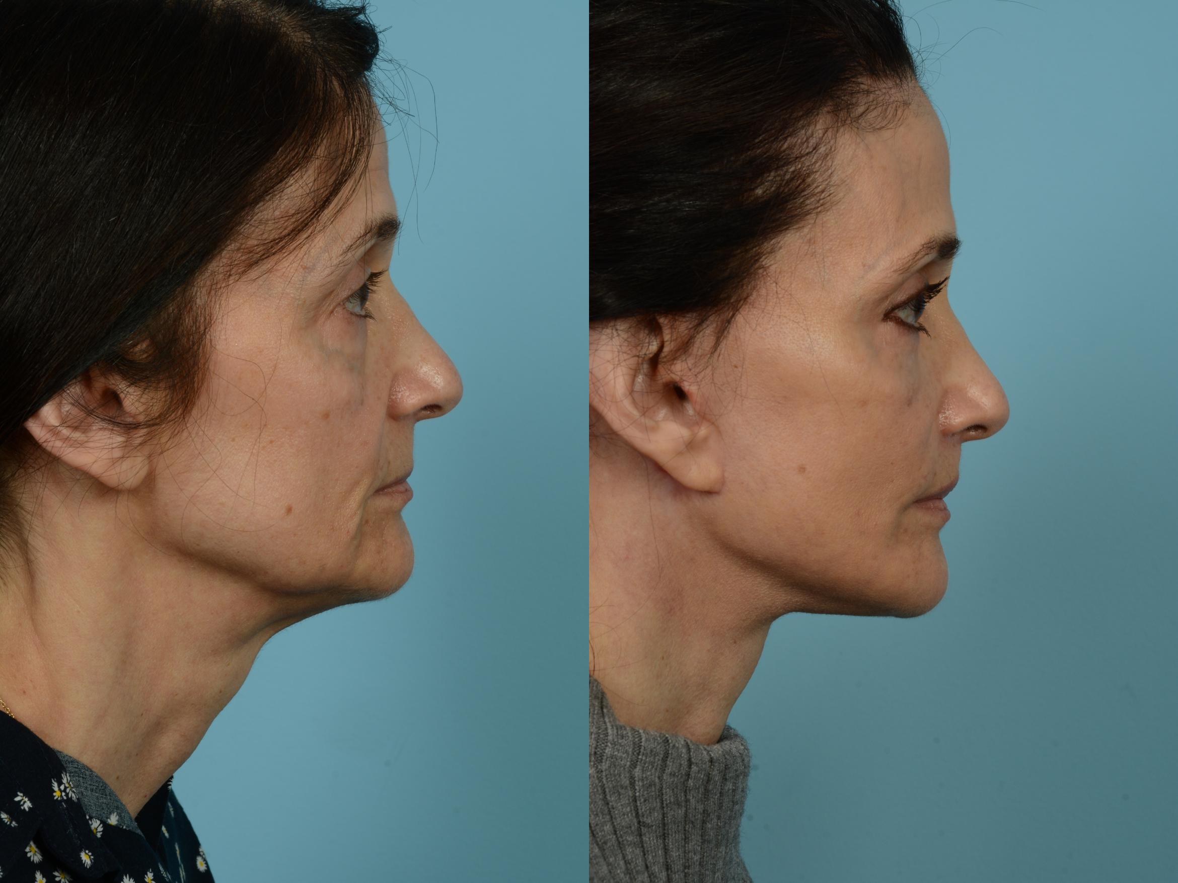 Before & After Facelift/Minilift Case 803 Right Side View in Chicago, IL