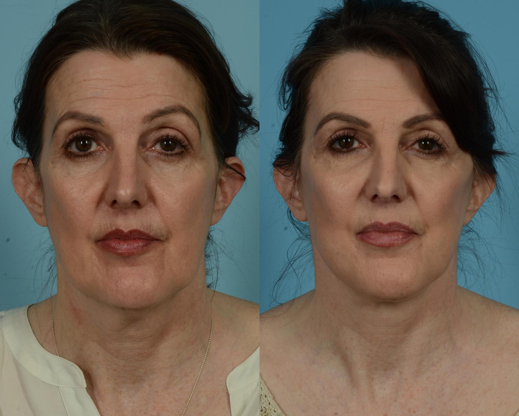 Before & After Deep Plane Facelift by Dr. Mustoe Case 1036 Front View in Chicago, IL
