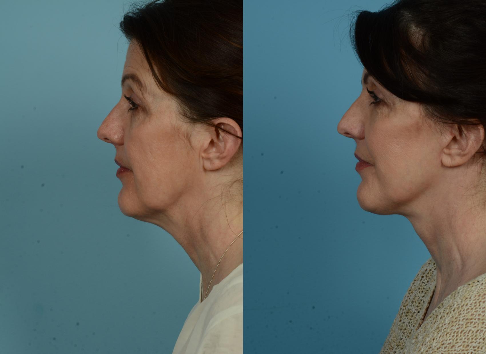 Before & After Facelift/Minilift by Dr. Mustoe Case 1036 Left Side View in Chicago, IL