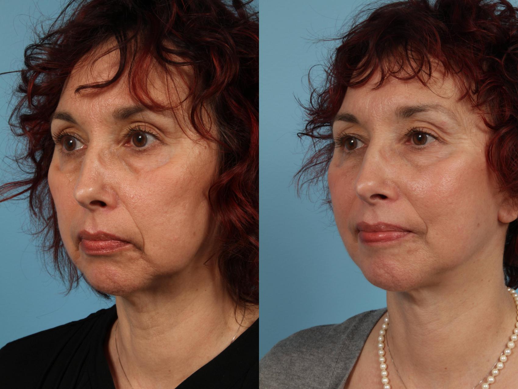 Before & After Deep Plane Facelift by Dr. Mustoe Case 104 View #1 View in Chicago, IL