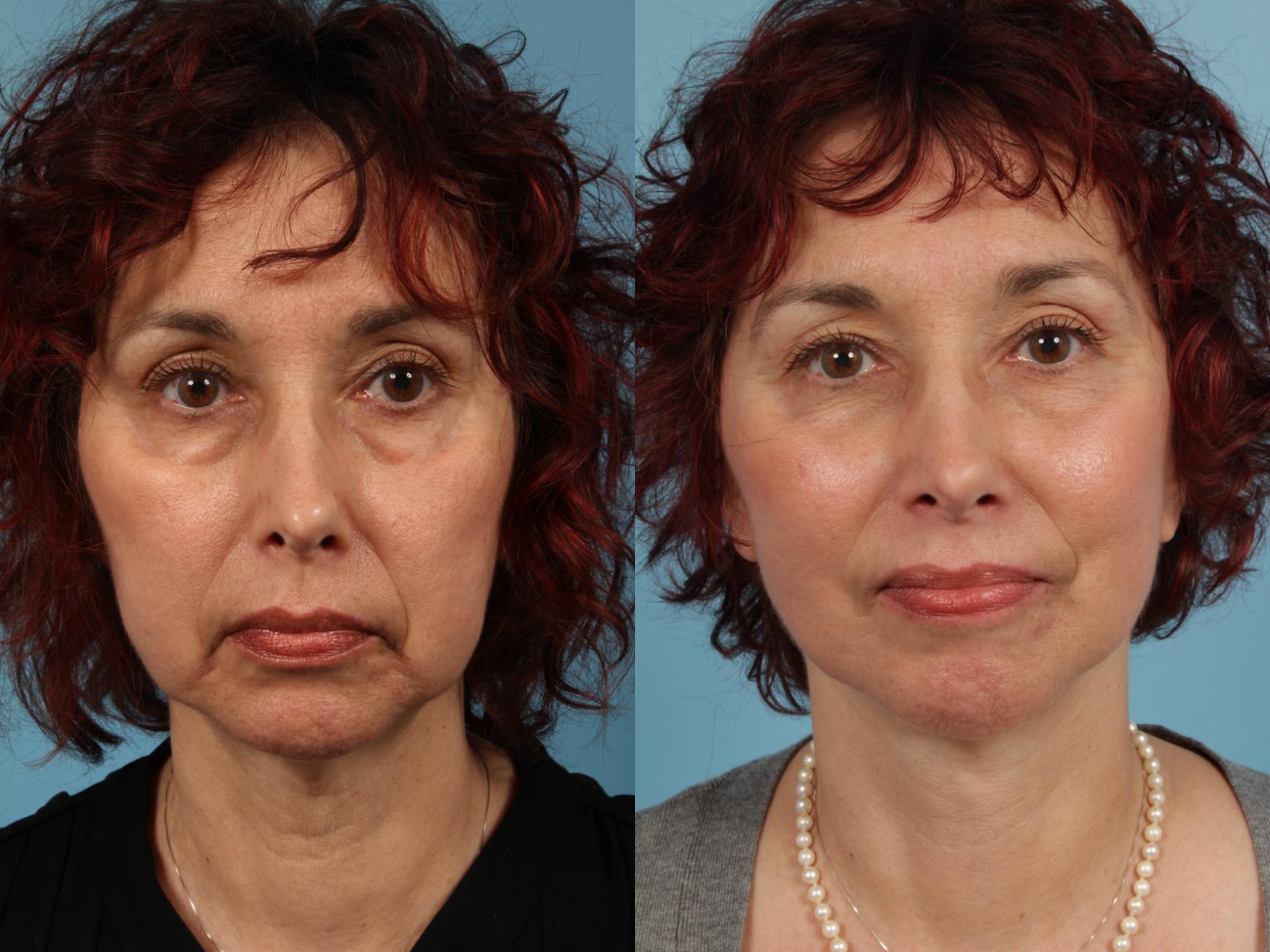 Before & After Facelift/Minilift by Dr. Mustoe Case 104 View #2 View in Chicago, IL