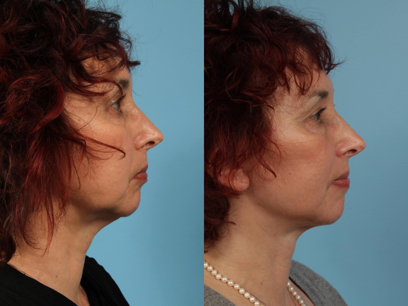 Before & After Deep Plane Facelift by Dr. Mustoe Case 104 View #4 View in Chicago, IL