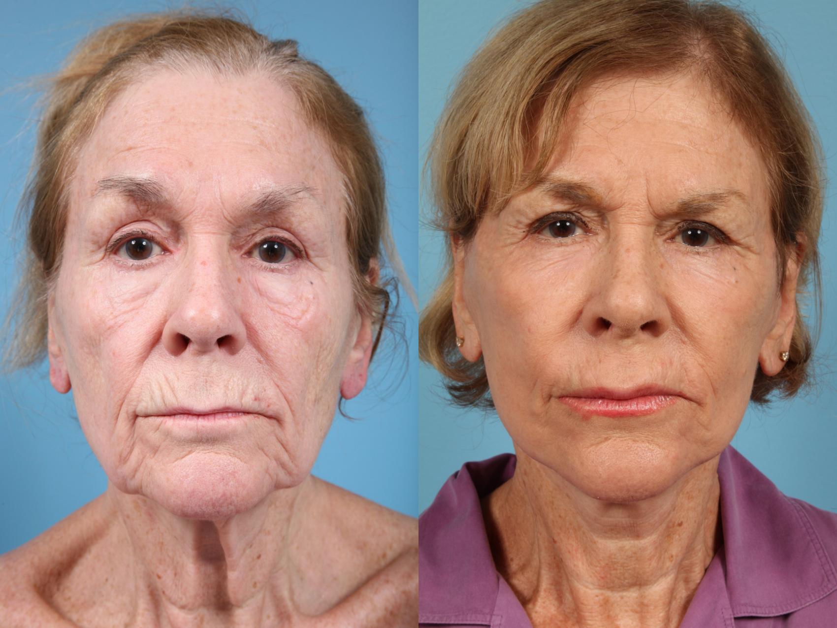 Before & After Facelift/Minilift by Dr. Mustoe Case 123 View #2 View in Chicago, IL