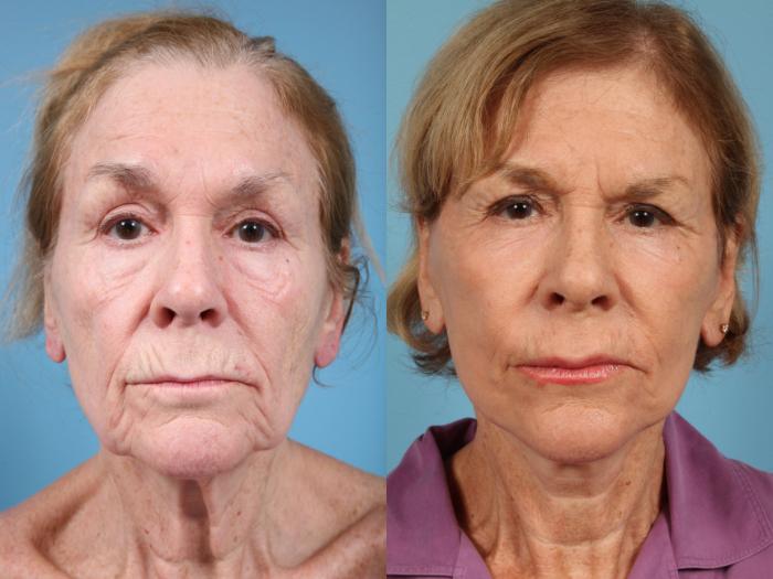 Before & After Fat Grafting by Dr. Mustoe Case 123 View #2 View in Chicago, IL