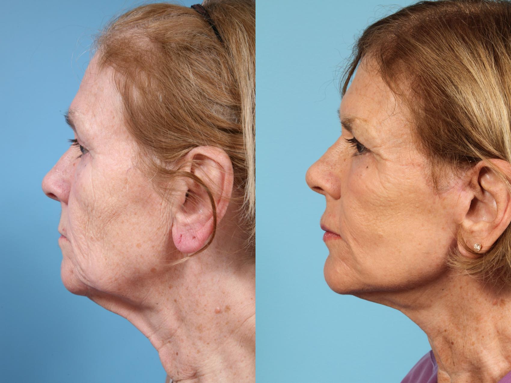 Before & After Fat Grafting by Dr. Mustoe Case 123 View #3 View in Chicago, IL