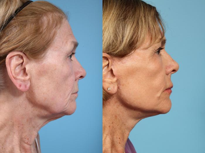 Before & After Fat Grafting by Dr. Mustoe Case 123 View #4 View in Chicago, IL