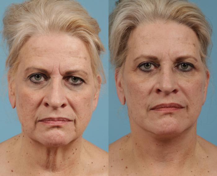 Before & After Facelift/Minilift by Dr. Mustoe Case 155 Front View in Chicago, IL