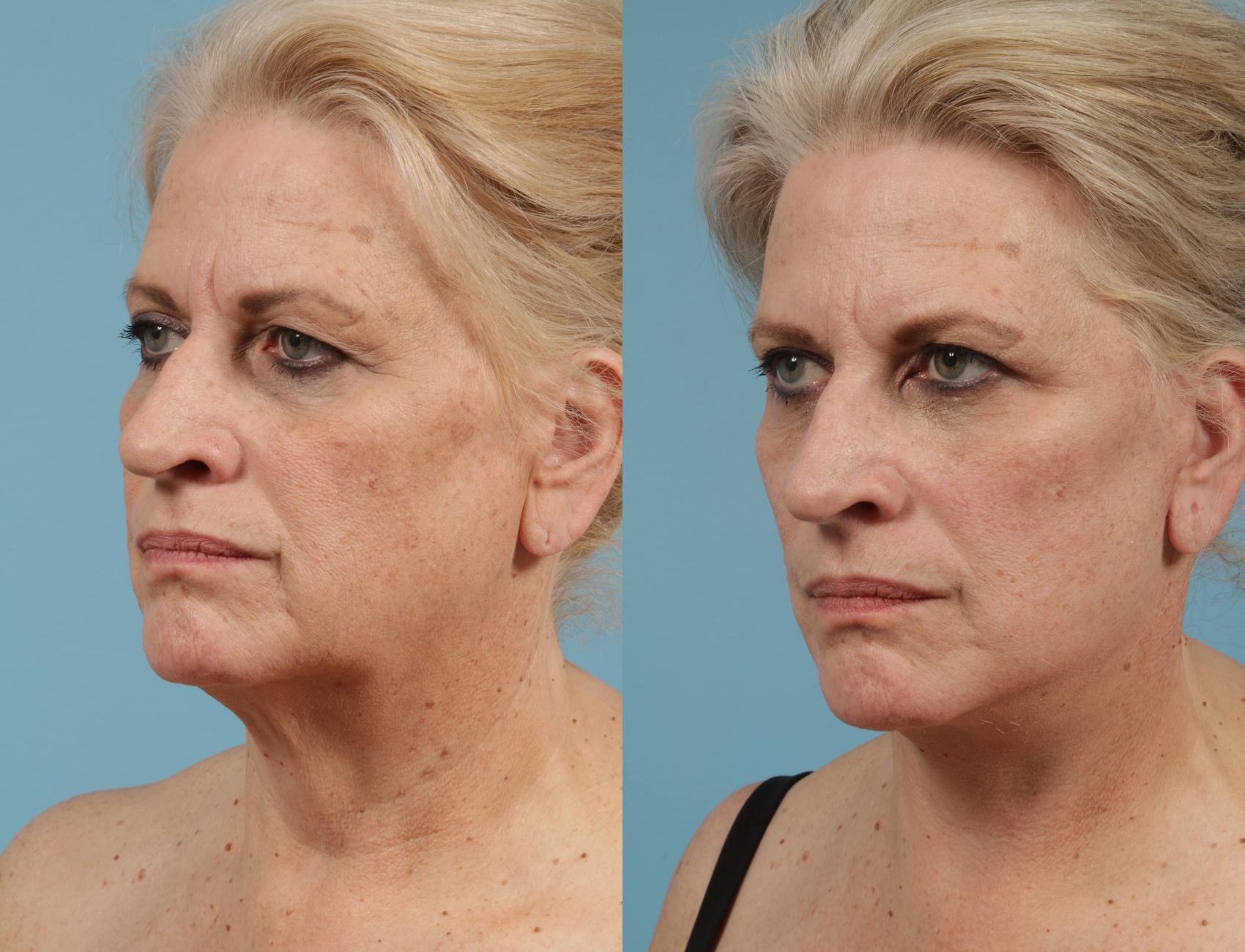 Before & After Facelift/Minilift by Dr. Mustoe Case 155 Left Oblique View in Chicago, IL