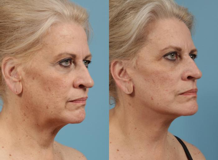 Before & After Blepharoplasty by Dr. Mustoe Case 155 Right Oblique View in Chicago, IL