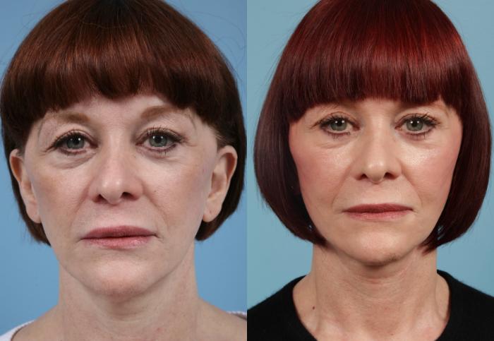 Before & After Neck Lift by Dr. Mustoe Case 156 Front View in Chicago, IL