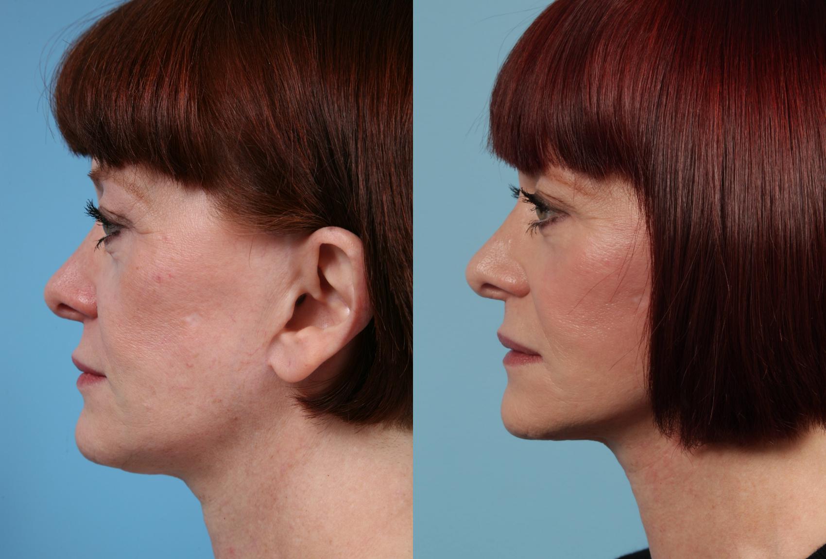 Before & After Neck Lift by Dr. Mustoe Case 156 Left Side View in Chicago, IL