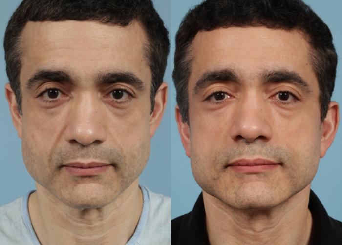 Before & After Facelift/Minilift by Dr. Mustoe Case 164 Front View in Chicago, IL