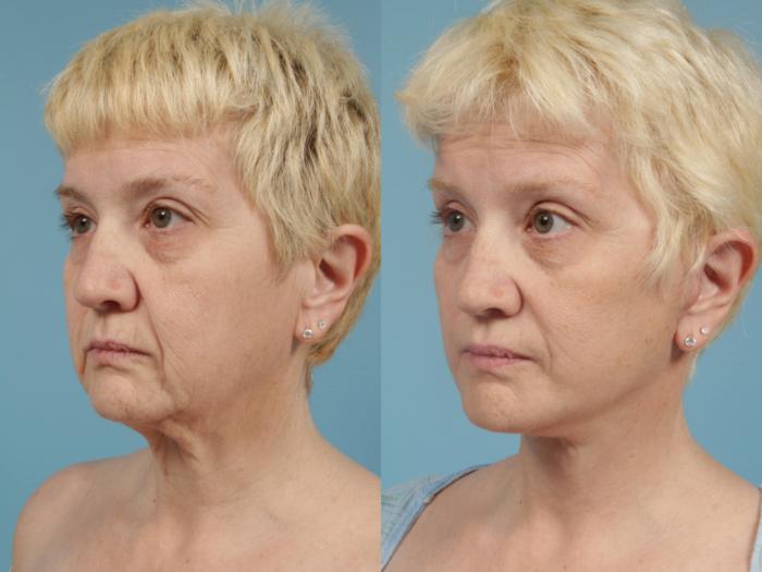 Before & After Facelift/Minilift by Dr. Mustoe Case 170 Left Oblique View in Chicago, IL