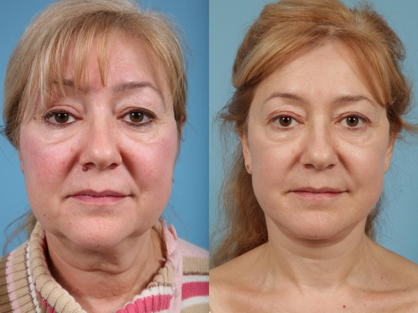 Before & After Facelift/Minilift by Dr. Mustoe Case 183 View #1 View in Chicago, IL