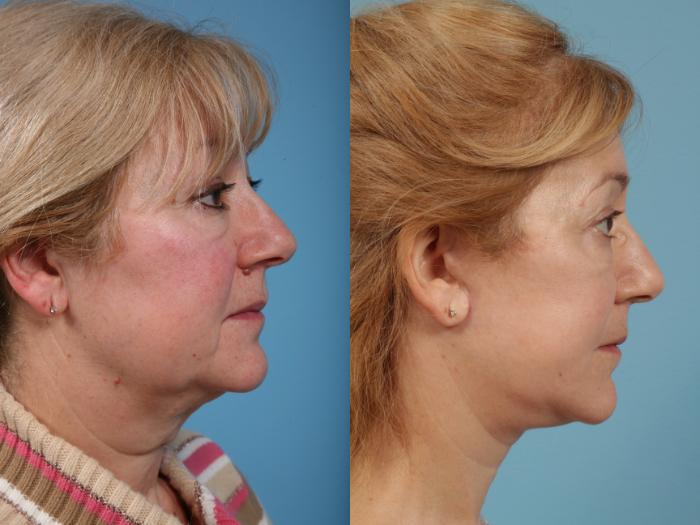 Before & After Facelift/Minilift by Dr. Mustoe Case 183 View #3 View in Chicago, IL