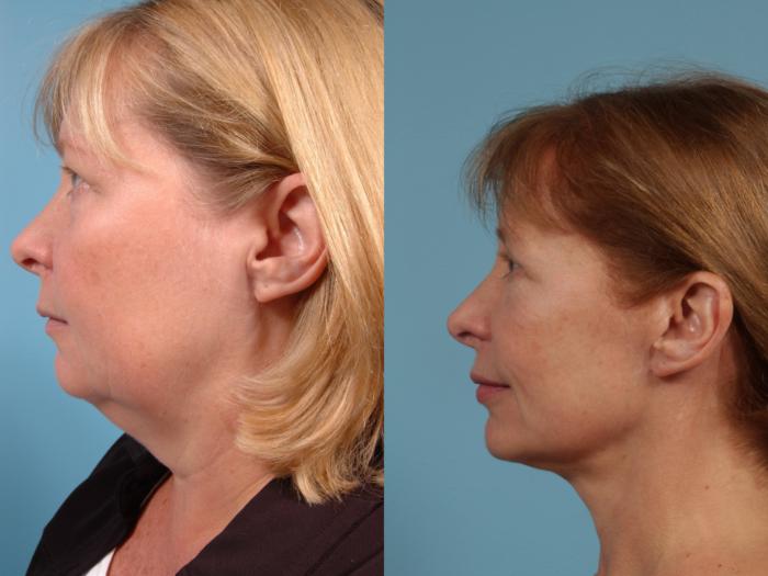 Before & After Facelift/Minilift by Dr. Mustoe Case 196 Left Side View in Chicago, IL