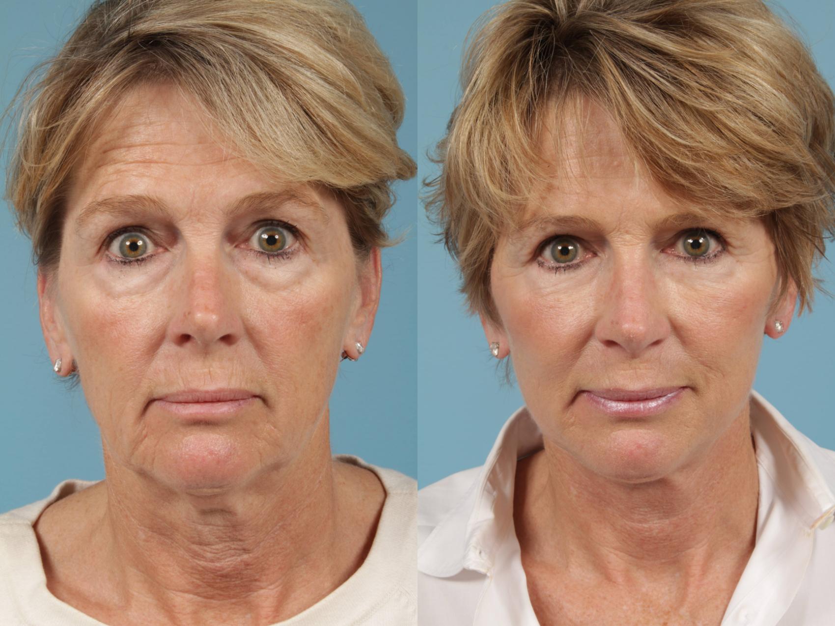 Before & After Facelift/Minilift by Dr. Mustoe Case 216 View #1 View in Chicago, IL