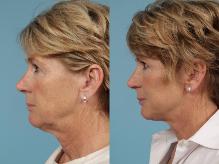Before & After Facelift/Minilift by Dr. Mustoe Case 216 View #4 View in Chicago, IL