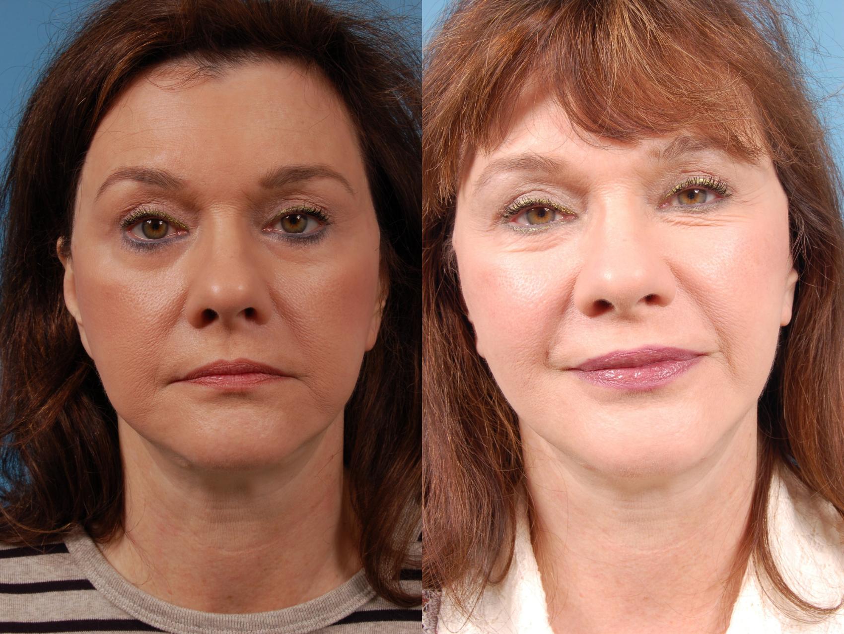 Before & After Facelift/Minilift by Dr. Mustoe Case 225 View #1 View in Chicago, IL