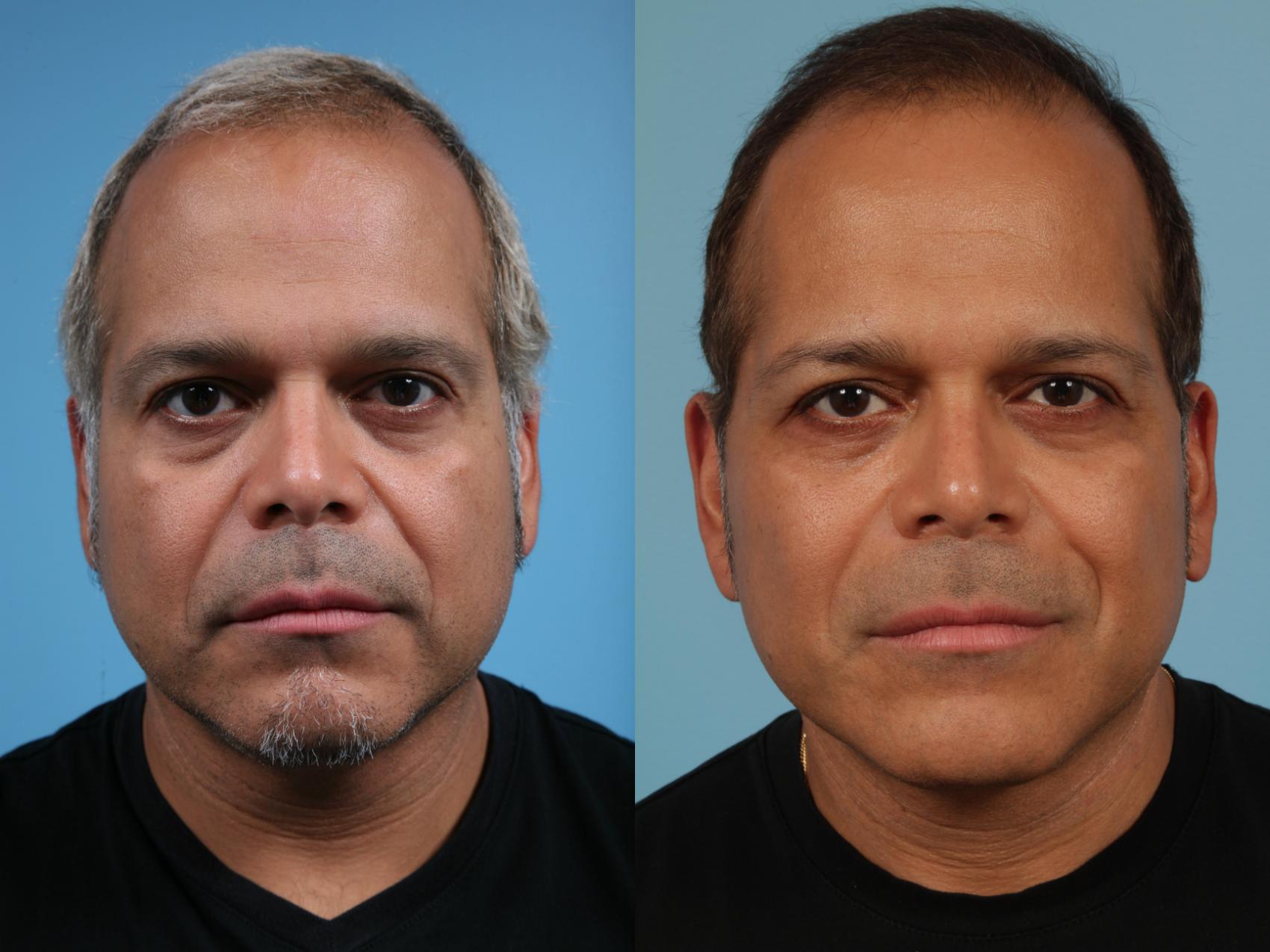 Before & After Facelift/Minilift by Dr. Mustoe Case 229 View #1 View in Chicago, IL